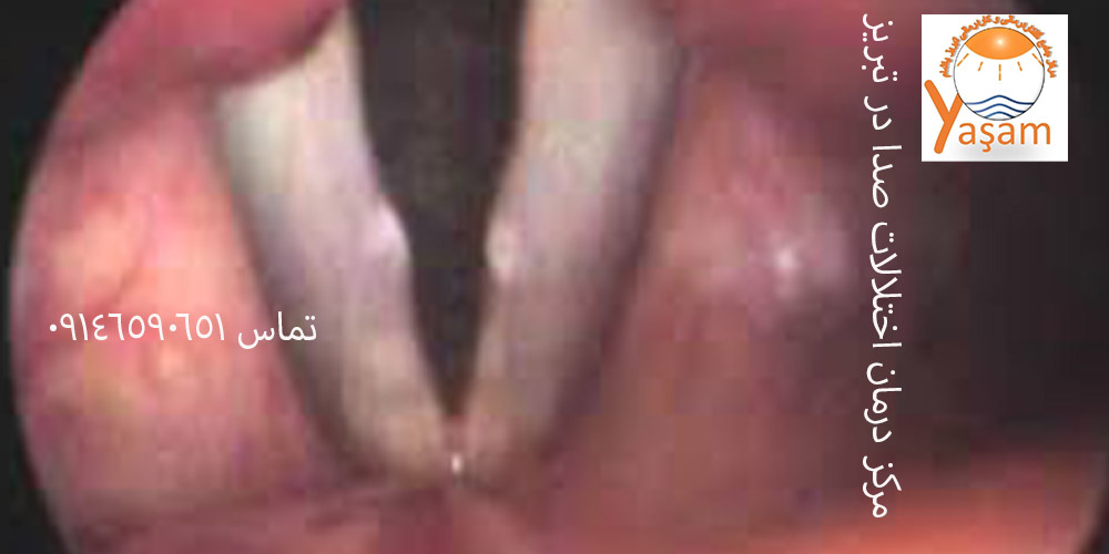 ندول تارهای صوتی