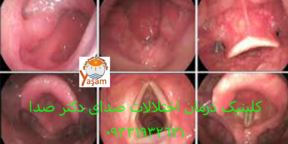زخم تماسی تارهای صوتی