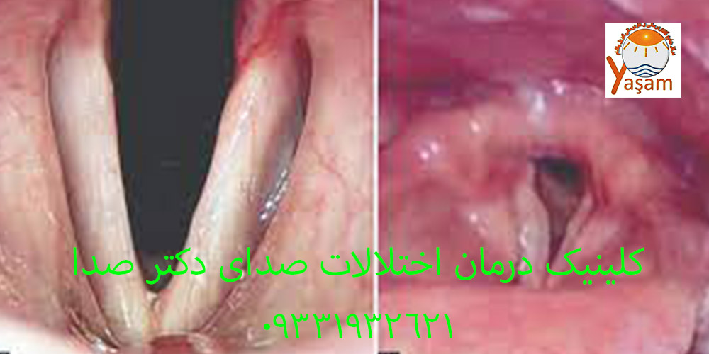 زخم تماسی تارهای صوتی