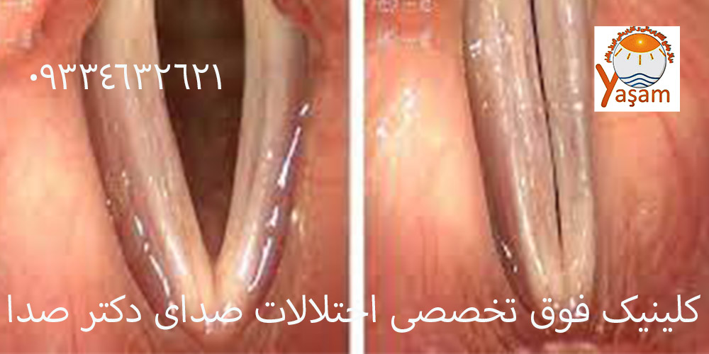 مربیان استخر و کیست صوتی