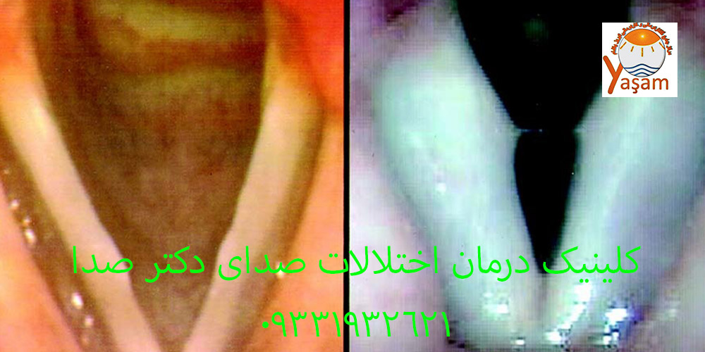 زخم تماسی تارهای صوتی