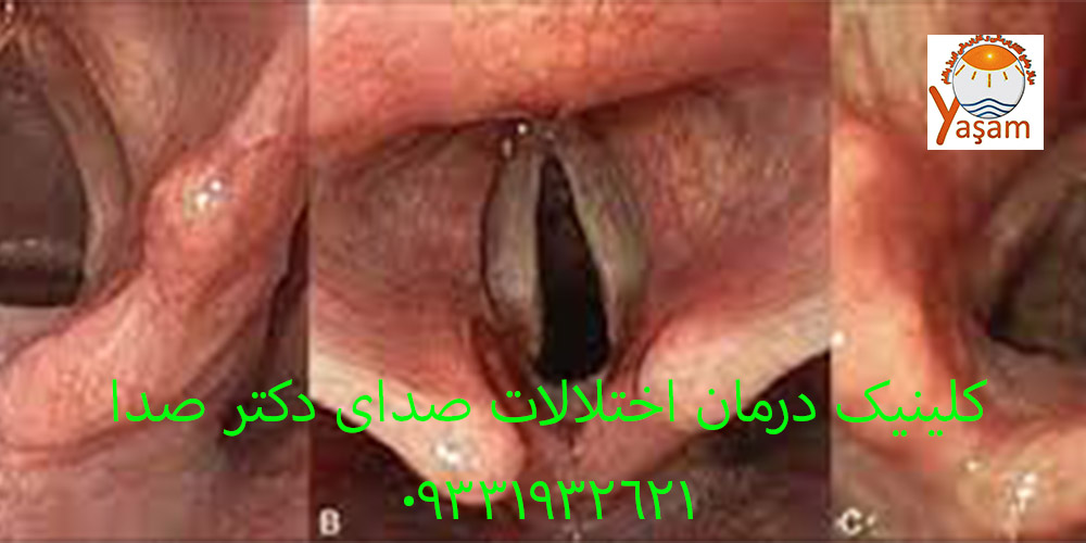 زخم تماسی تارهای صوتی
