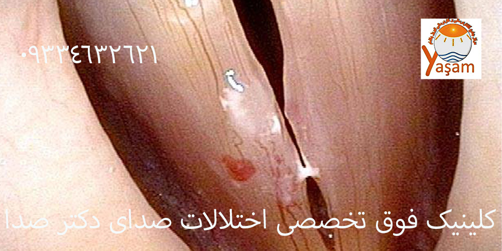مربیان استخر و کیست صوتی