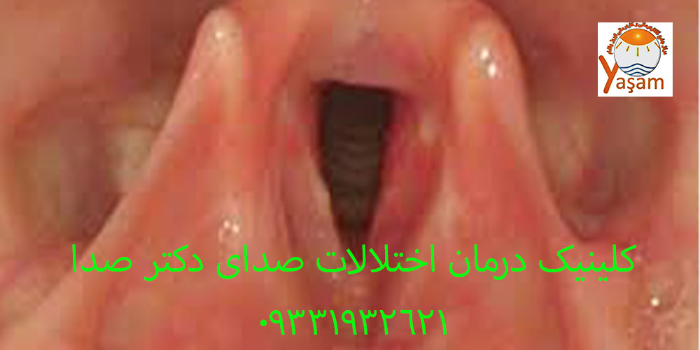 زخم تماسی تارهای صوتی