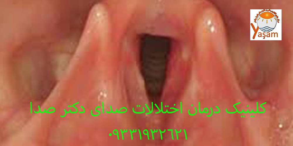 زخم تماسی تارهای صوتی
